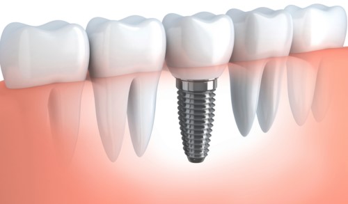Trồng Implant khi bị mất 1 răng có được không?