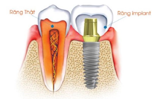 Trồng Răng Implant Nên Chọn Loại Trụ Nào?
