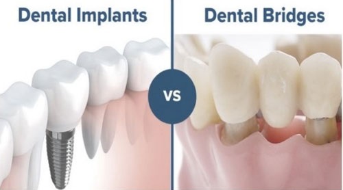 Nên trồng răng giả bằng cấy ghép Implant hay cầu răng sứ là tốt nhất?